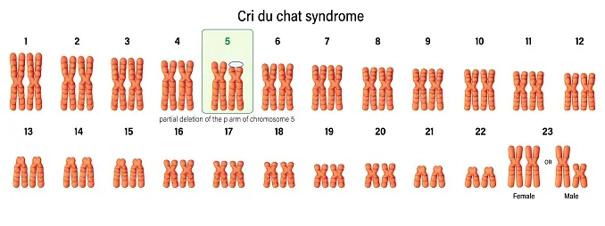 Karyotype of Cri du chat syndrome. Autosomal abnormalities.