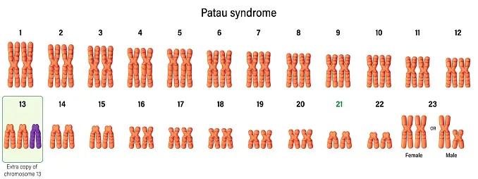 Karyotype of Patau syndrome. Autosomal abnormalities. Trisomy 13