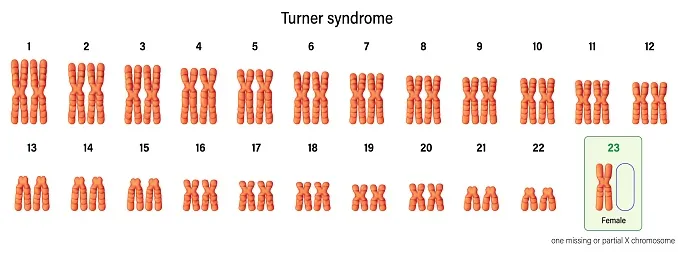 Karyotype of Turner syndrome