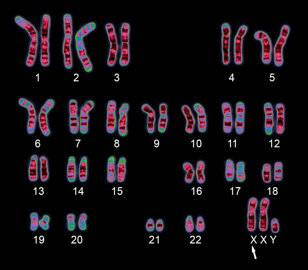 Klinefelter's Syndrome